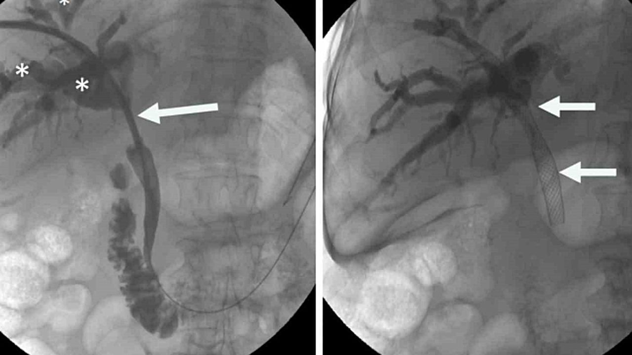 Hibrit yaklaşımla, zorlu safra yolu tedavilerinde yeni dönem