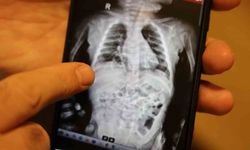 200 binde bir görülen hastalık