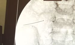 Ağrıyla kıvranan 2 yaşındaki çocuğun bağırsağından 3 santimlik iğne çıktı