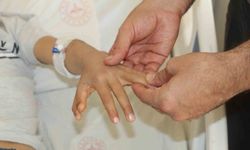 Yapışık parmaklı iki kardeş ameliyatla sağlıklarına kavuştu