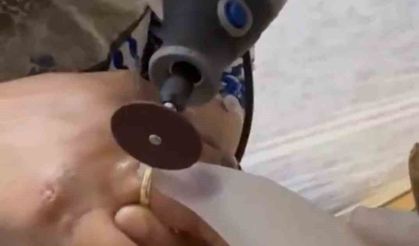 Kazada yaralanan kadının parmağına sıkışan yüzüğü itfaiye ekipleri çıkardı
