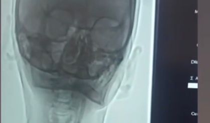 Iğdır'da şah damarı darlığına stentli müdahale