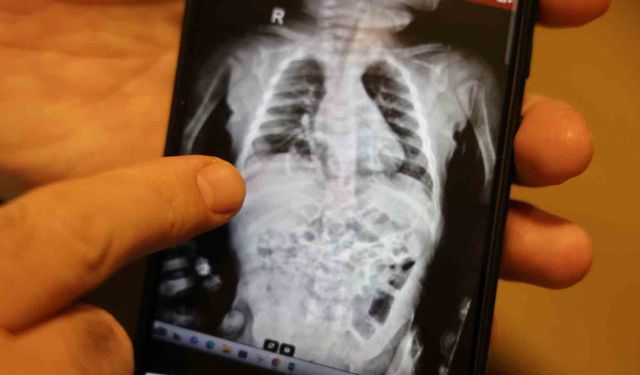 200 binde bir görülen hastalık